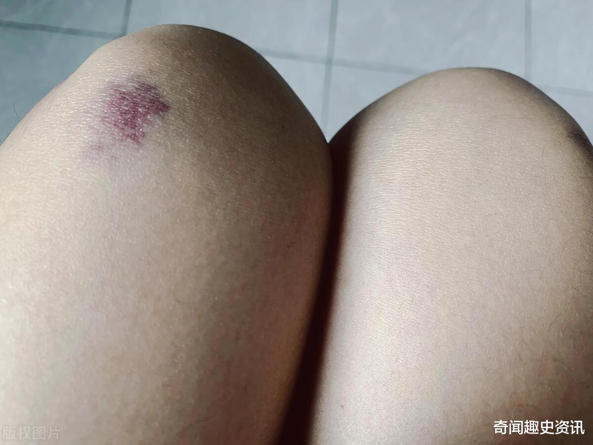 为何女生身体更容易出现淤青为何女生身体更容易出现淤青，深度解析与理解